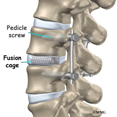 Back Surgery vs. Non-surgical Decompression Therapy For Spinal Relief