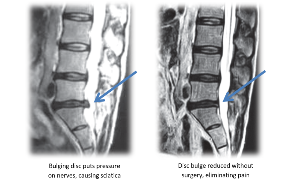 Back Surgery vs. Non-surgical Decompression Therapy For Spinal Relief