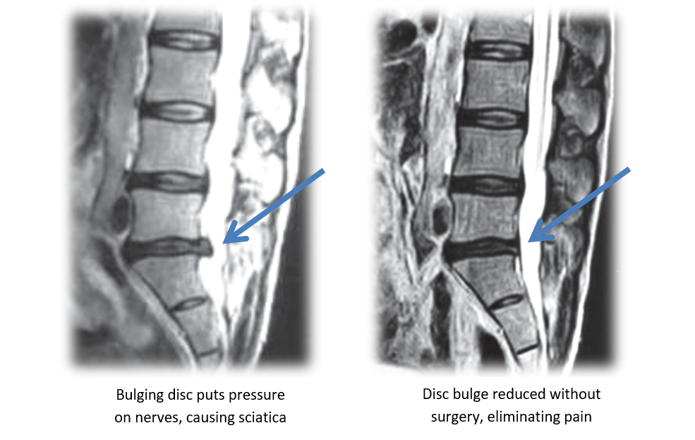 MRI Before and After