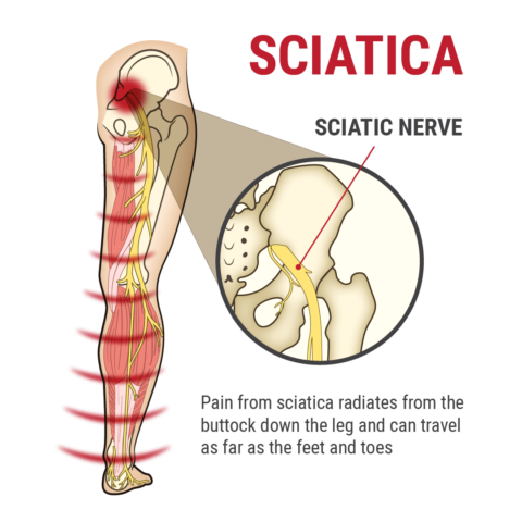 Edmonds Sciatica Treatment & Relief | Olympic Spine & Sports Therapy