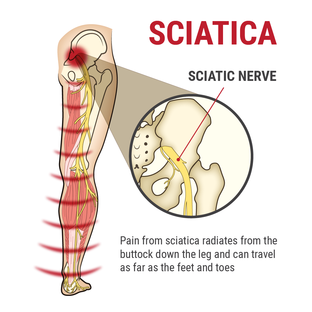 Боль при повреждении нерва. Седалищный нерв (sciatic nerve)? 011. Повреждение седалищного нерва при травме. Седалищный нерв грыжа позвоночника.