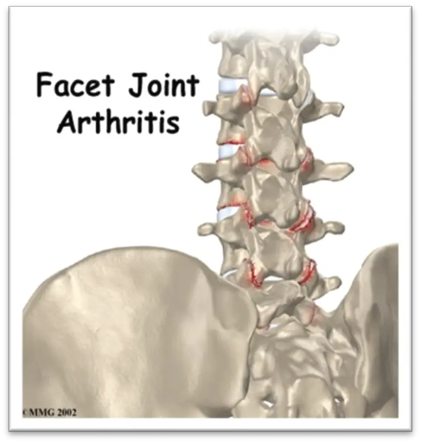 Facet Join Arthritis Example