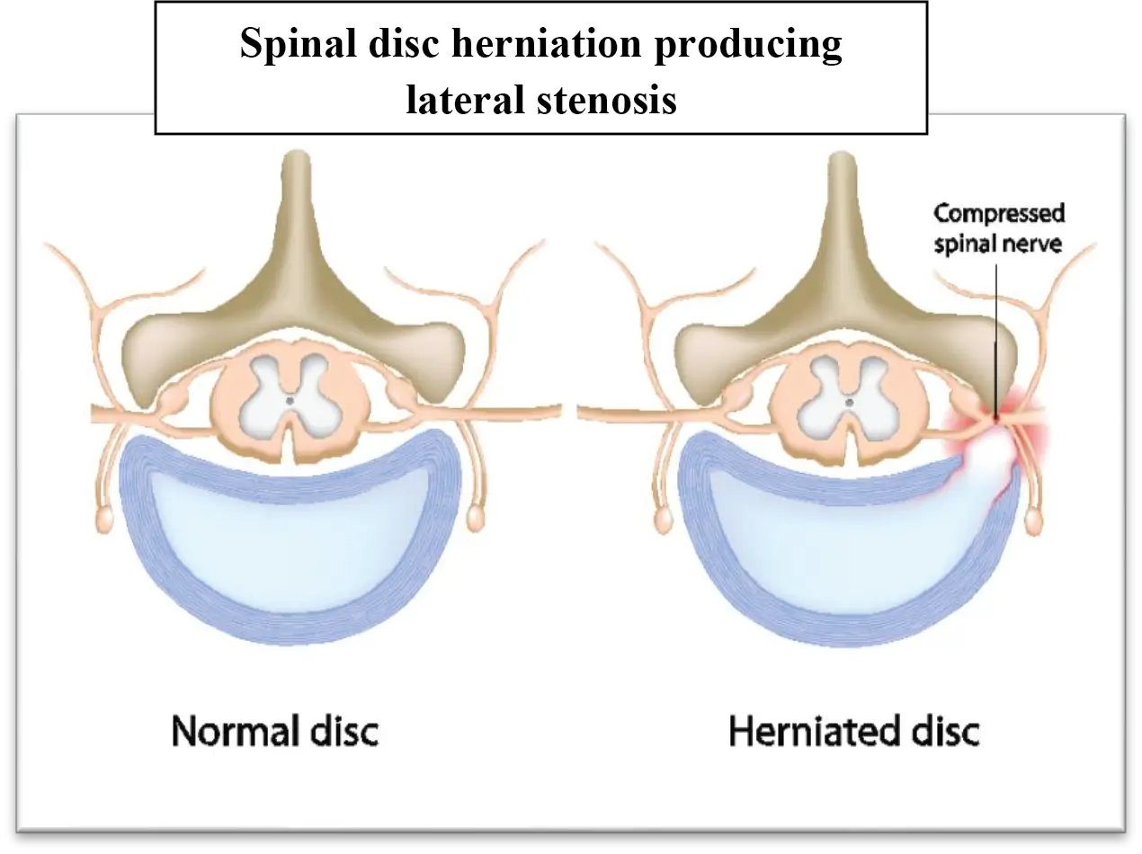 Spinal Disc Herniation Producing Lateral Stenosis