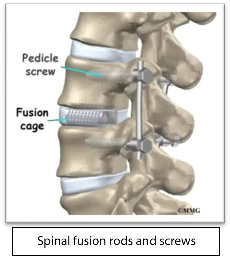 Spinal Fusion Rods and Screws