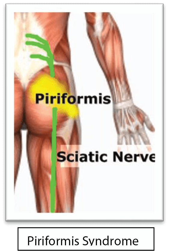 Piriformis Syndrome Diagram